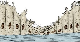 Ciliated epithelium of a smoker's respiratory tract