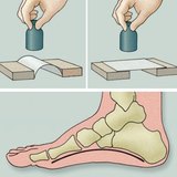 Examination of the arch of the foot