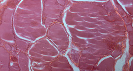 Τομή θυρεοειδούς αδένα