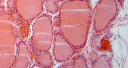 Τομή θυρεοειδούς αδένα