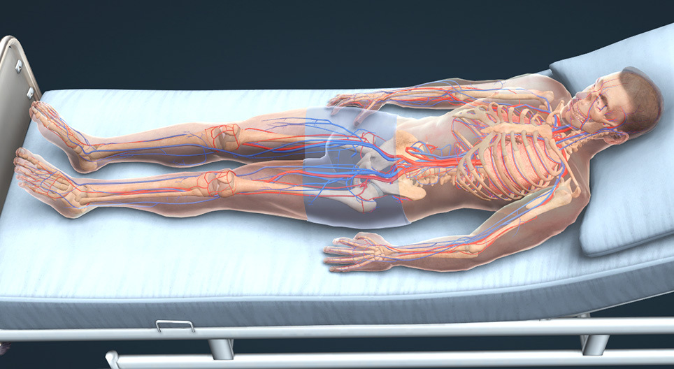 Zakrzepica żył głębokich i zatorowość płucna